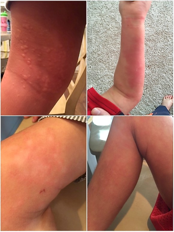 parkers-skin-allergies-2